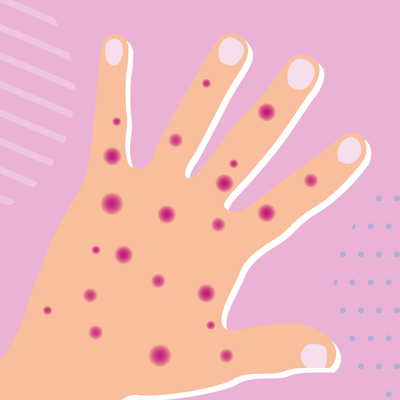 Bulaşıcı Hastalık Gerçek Zamanlı PCR Monkeypox Test Kiti MPXV CE Kayıtlı 1 Test/Kutu